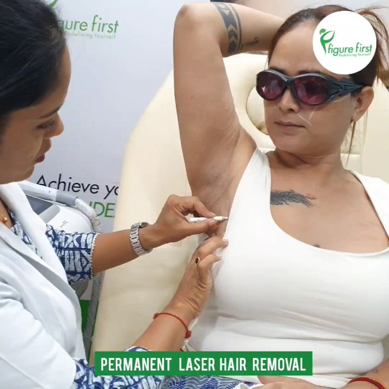 Permanent Underarm Laser Hair Removal Session